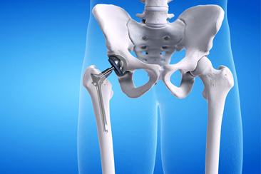 Hip Joint Replacement