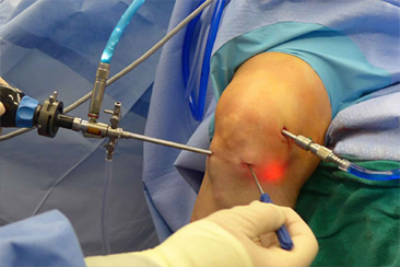 Knee Arthroscopy