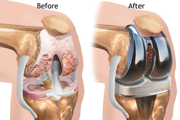 Knee Joint Replacement