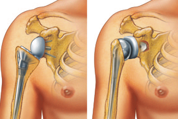 Shoulder Joint Replacement